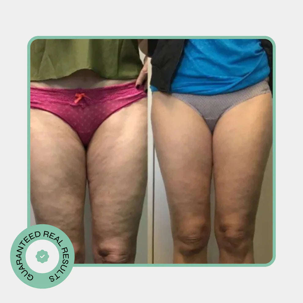 Celo Pro Cellulite Roller