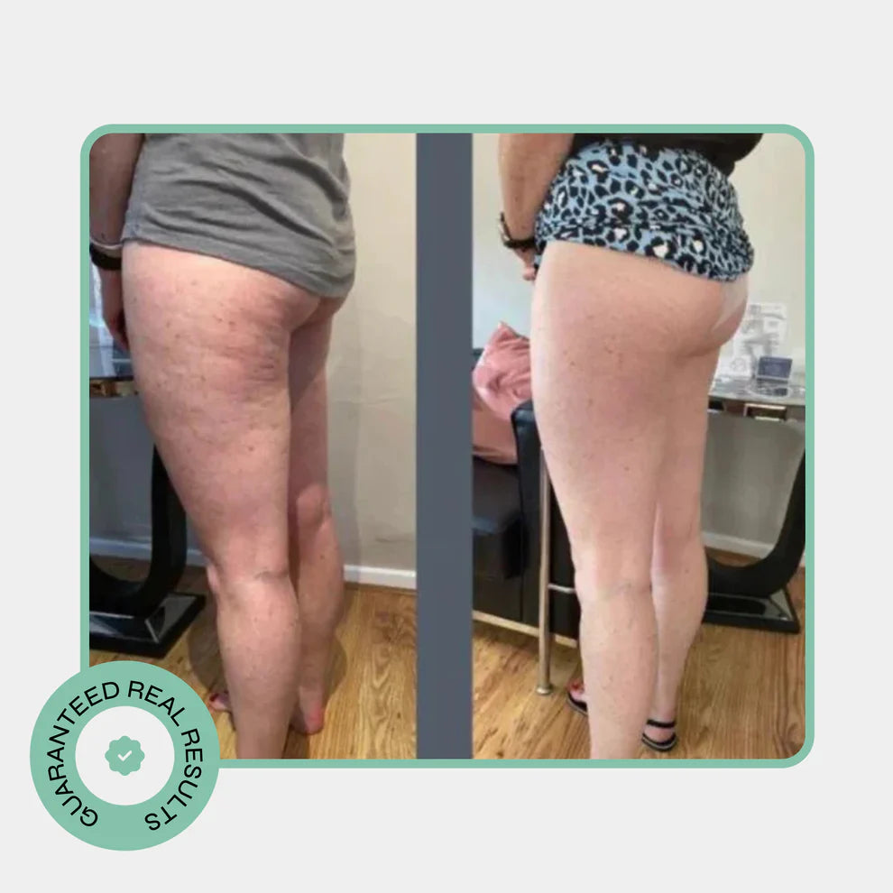 Celo Pro Cellulite Roller
